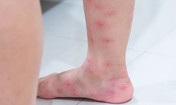 มดคันไฟกัด อย่านิ่งนอนใจ เพราะคุณอาจ แพ้มดคันไฟ