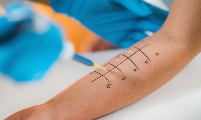 อยากรู้ว่าแพ้แมลงอะไรบ้าง ลองมา ทดสอบการแพ้แมลงกัดต่อย กัน