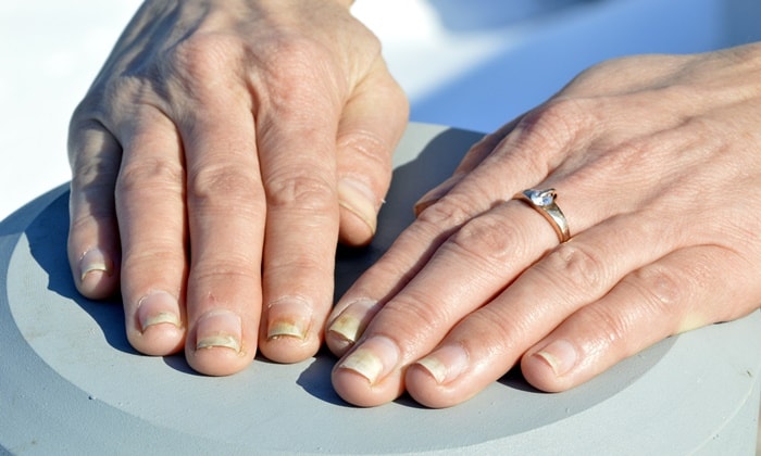 ปลายเล็บร่น (Onycholysis)