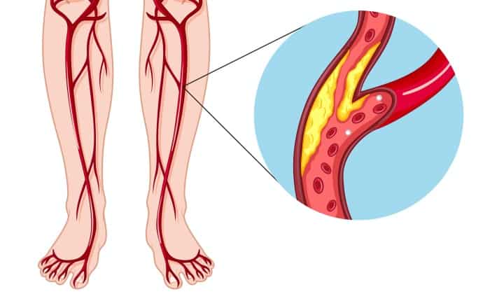หลอดเลือดแดงส่วนปลายอุดตัน (Peripheral Arterial Disease)