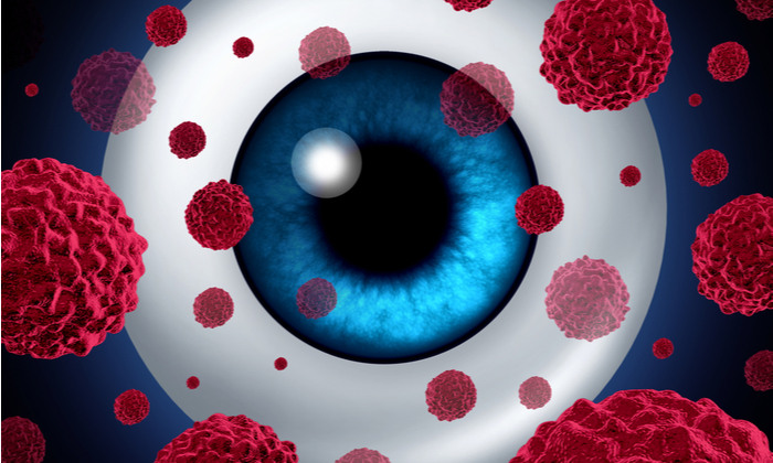 มะเร็งจอประสาทตาในเด็ก (Retinoblastoma)