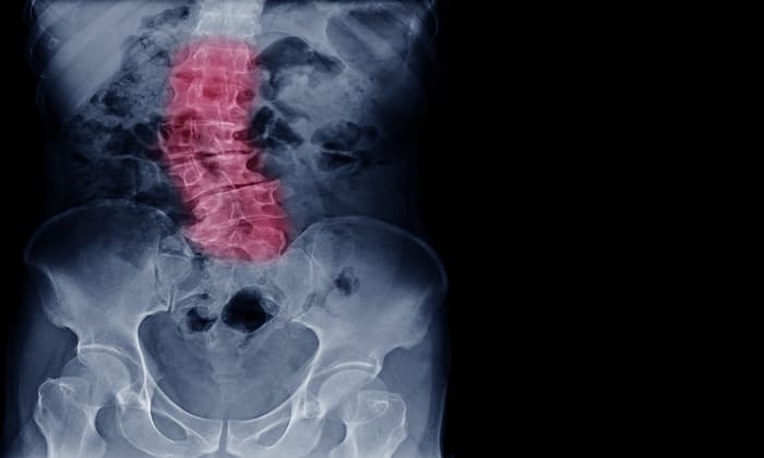 กระดูกสันหลังคด (Scoliosis)