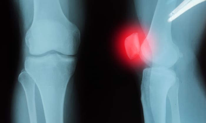 ข้ออักเสบจากการติดเชื้อ  (Septic Arthritis)