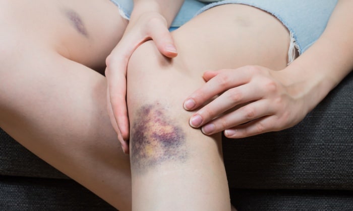 ไขข้อสงสัยทำไม สีรอยช้ำ ถึงมีสีที่แตกต่างกัน