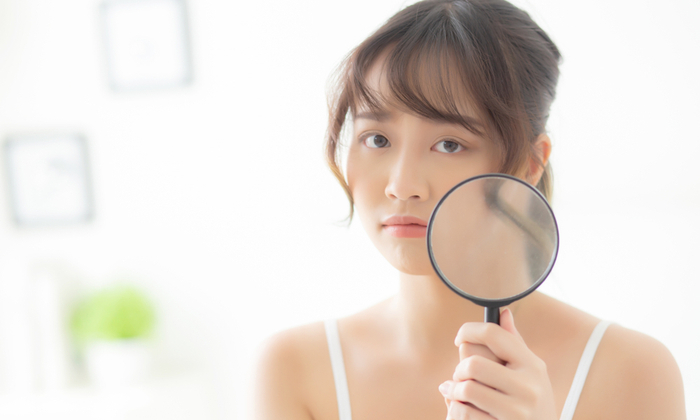 สิวฮอร์โมน สาเหตุ และวิธีรักษา