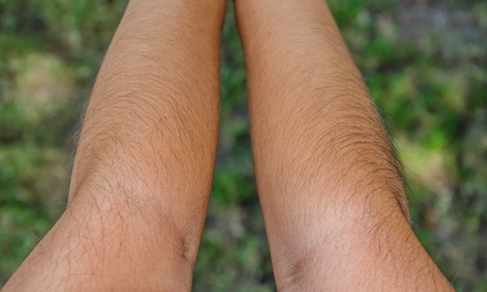 โรคมนุษย์หมาป่า คืออะไร มีสาเหตุ และวิธีรักษาอย่างไร