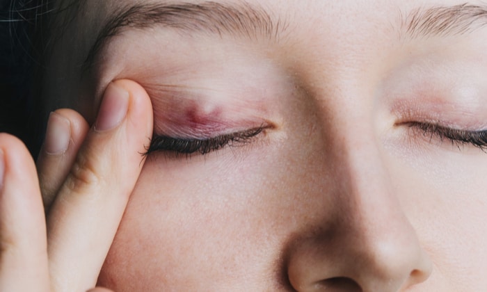 ตากุ้งยิงชนิดไม่เจ็บ (Chalazion)