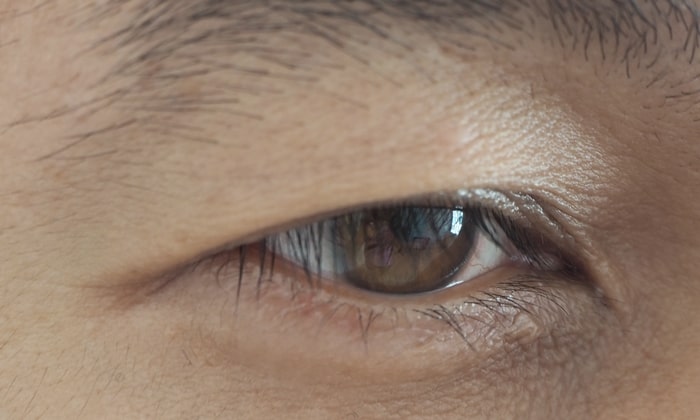 ตาตก หย่อนคล้อย จนทำให้ดูแก่ก่อนวัย สามารถรักษาได้อย่างไร