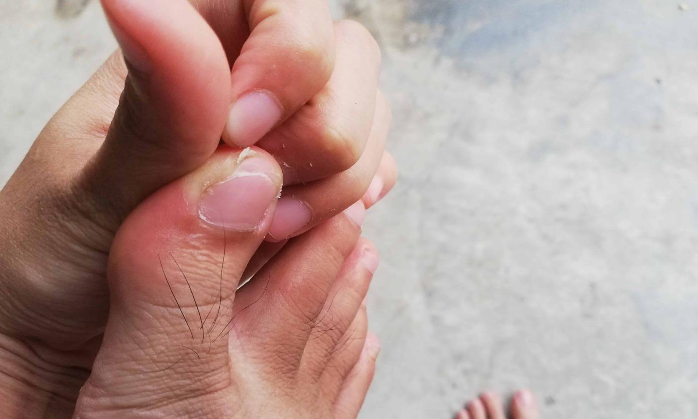 โรคแกะผิวหนัง ภาวะสุขภาพจิตที่ไม่ควรมองข้าม