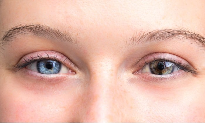 ตาสองสี (Heterochromia)