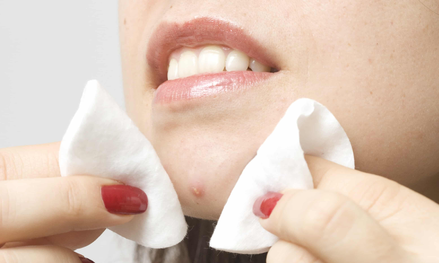 บีบสิว ออกได้หรือไม่ หากเป็นสิวเยอะมาก