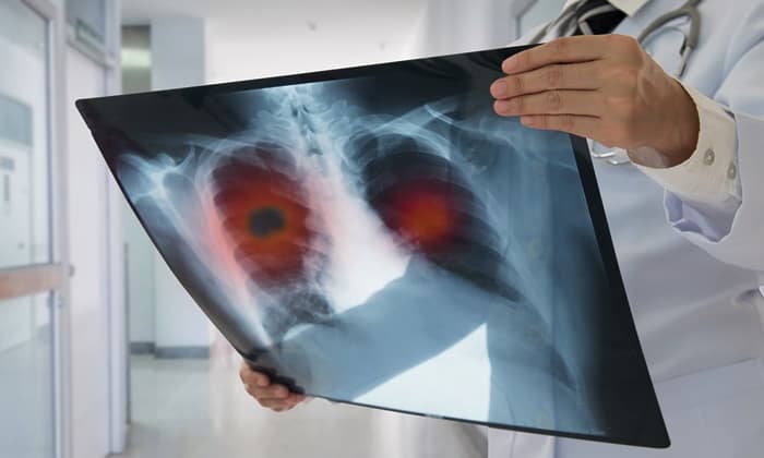 ความเชื่อเกี่ยวกับมะเร็งปอด 7 เรื่องนี้ อันไหนจริง อันไหนหลอก มาดูกัน