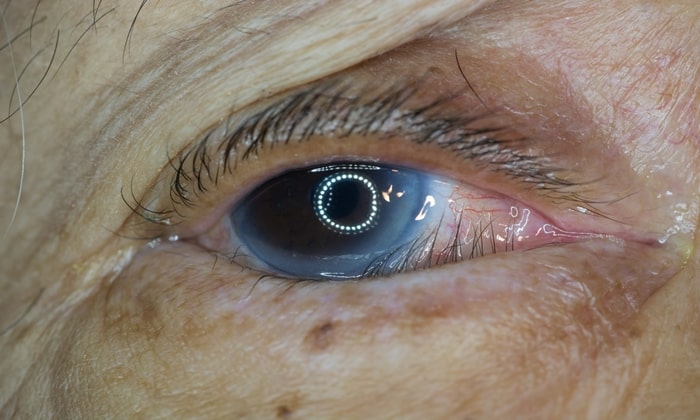 ภาวะเปลือกตาม้วนเข้า (Entropion)