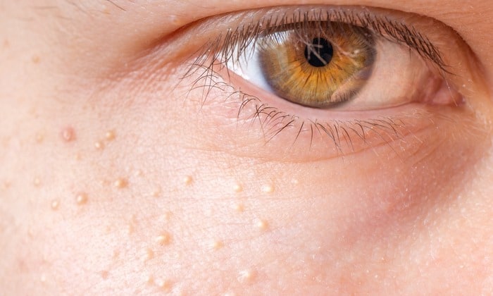 สิวหิน ก้อนซีสต์บนใบหน้าที่รักษาให้หายได้