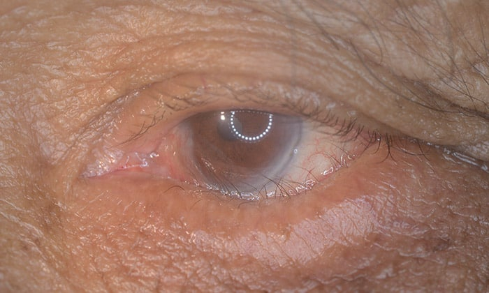 ภาวะเปลือกตาม้วนออก (Ectropion)