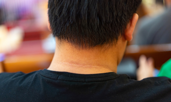 ผิวหนังช้าง สาเหตุ อาการ และการรักษา