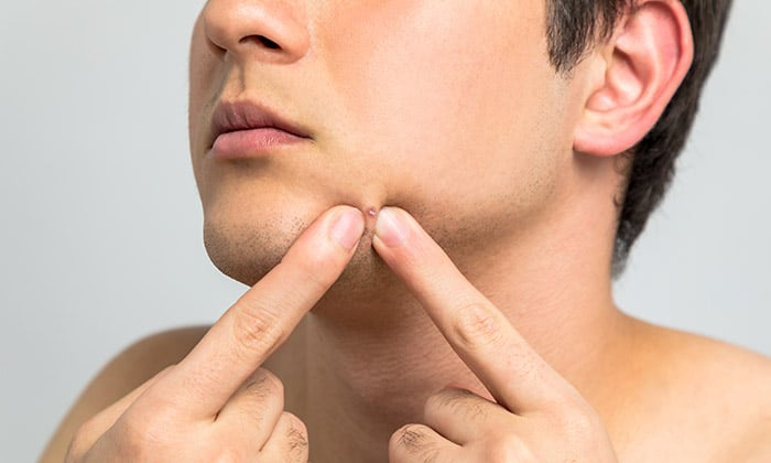 วิตามินลดสิว ช่วยได้จริงไหม อยู่ในอาหารชนิดใดบ้าง