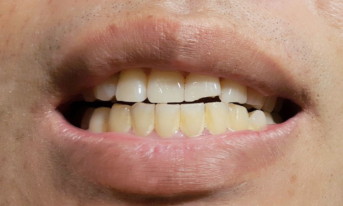 ขี้ฟัน ต้นเหตุสำคัญ ของกลิ่นปาก ที่ไม่ควรมองข้าม