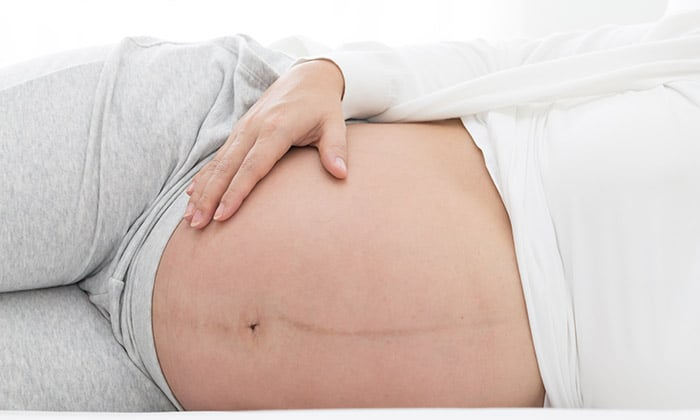 เส้นสีดำบนท้อง ตอนตั้งครรภ์ เกิดจากอะไร