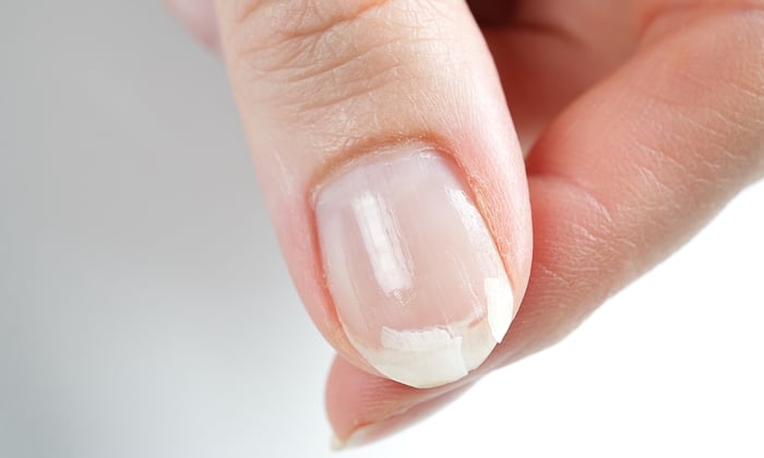 เล็บฉีก วิธีปฐมพยาบาล และวิธีป้องกัน