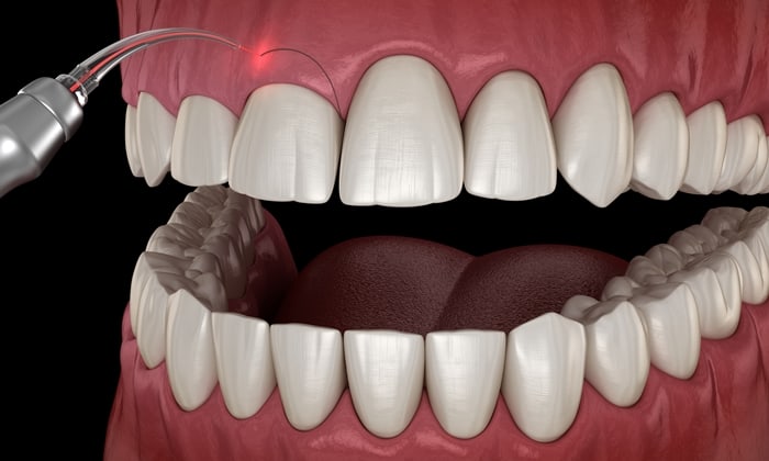 ตัดเหงือก (Gingivectomy)