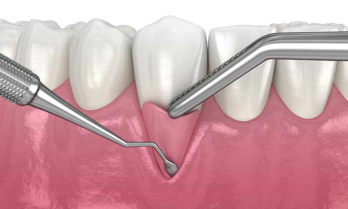 ปลูกถ่ายเหงือก (Gum Tissue Graft)