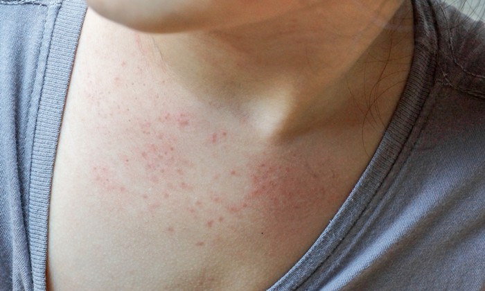 ส่าไข้ สาเหตุ อาการ การรักษาและป้องกัน