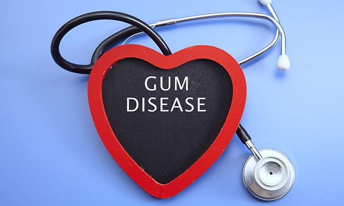 โรคเหงือกกับโรคหัวใจ ส่งผลต่อกันได้อย่างไร