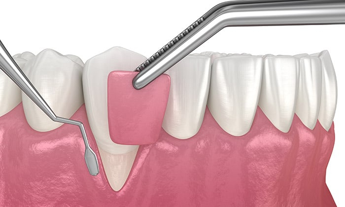 ศัลยกรรมปลูกถ่ายเหงือก (Gum Tissue Graft) ทางออกสำหรับผู้ที่มีปัญหา เหงือกร่น