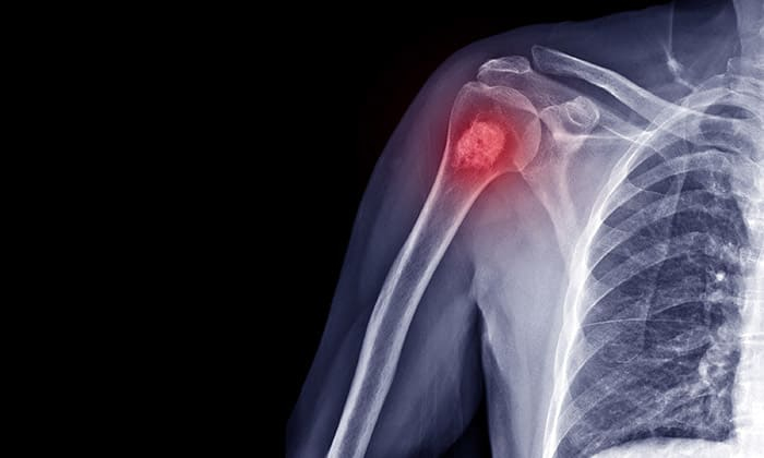 เนื้องอกกระดูกอ่อน (Enchondroma)