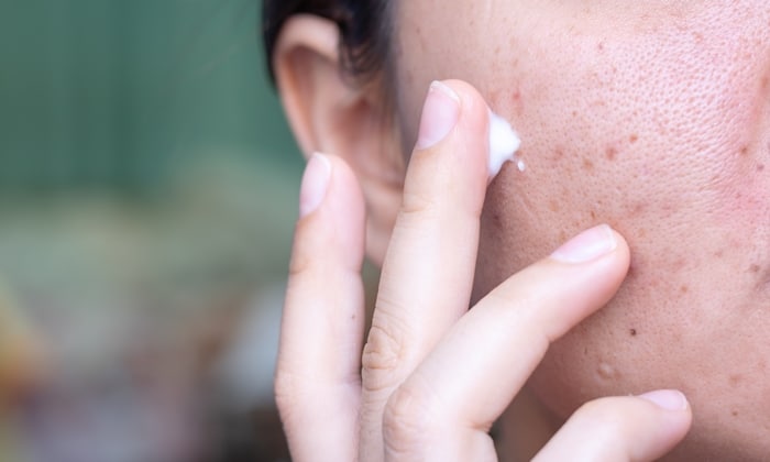 จุดด่างดำ แย่ลงช่วยอากาศแห้ง ควรรับมืออย่างไร