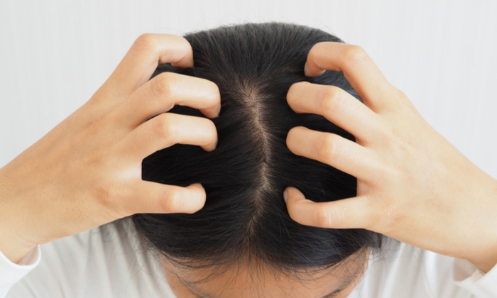 สะเก็ดเงินที่หนังศีรษะ (Scalp Psoriasis)
