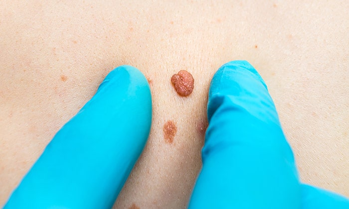 กำจัดติ่งเนื้อบนผิวหนัง ทำได้อย่างไรบ้าง