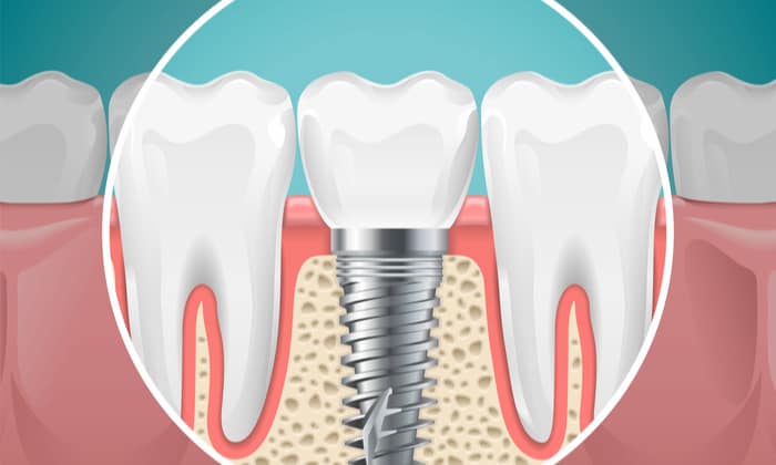 การผ่าตัดใส่ รากฟันเทียม มีข้อดี และความเสี่ยง อย่างไร
