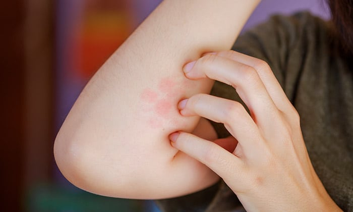 วิธีรักษา กลาก ด้วยวัตถุดิบใกล้ตัว