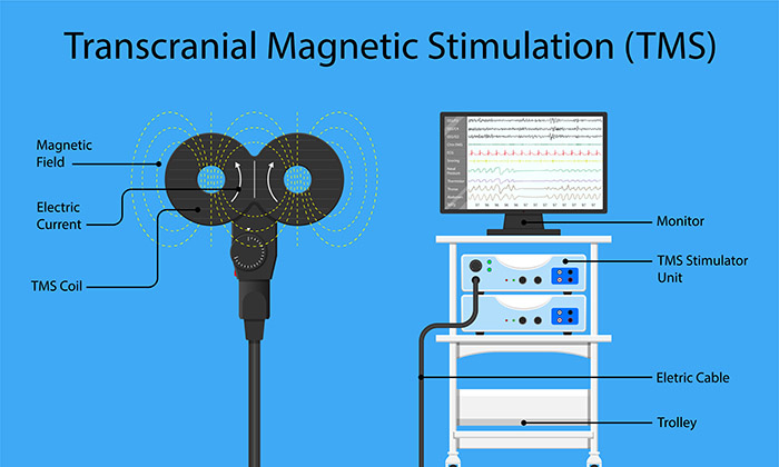 ทีเอ็มเอส (TMS) เครื่องกระตุ้นระบบประสาท ที่ช่วยในการรักษาโรคซึมเศร้า