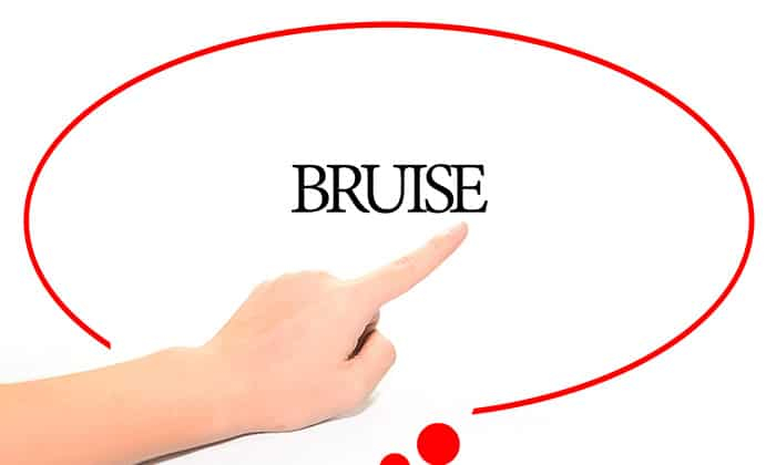 รอยช้ำกับห้อเลือด มีความแตกต่างกันอย่างไร