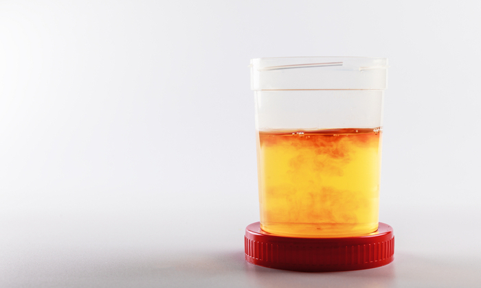 ปัสสาวะเป็นเลือด (Hematuria)