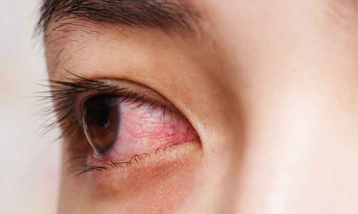 เป็นเยื่อบุตาอักเสบ จะเยียวยารักษาได้อย่างไรบ้าง