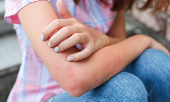 บรรเทาอาการแพ้แมลง สำหรับอาการแพ้รุนแรงและไม่รุนแรง