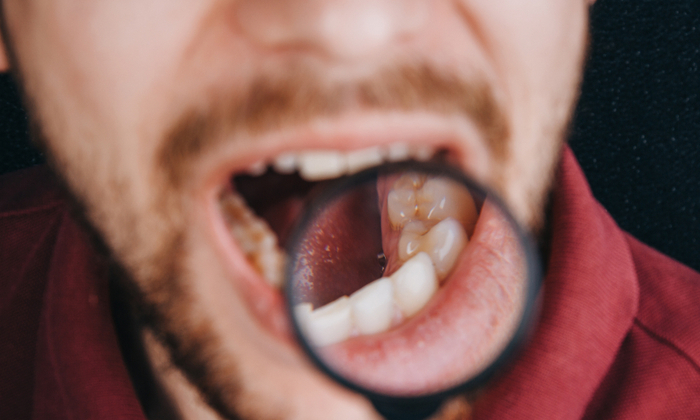 เรื่องที่คุณควรรู้เกี่ยวกับ มะเร็งช่องปาก (Oral Cancer)