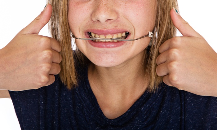 ทำความรู้จักกับ การจัดฟันแบบเฮดเกียร์ ทางเลือกเพื่อฟันสวยของลูกน้อย