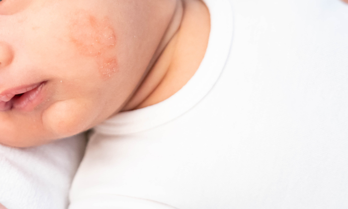 กลากน้ำนม อาการ สาเหตุ และการรักษา