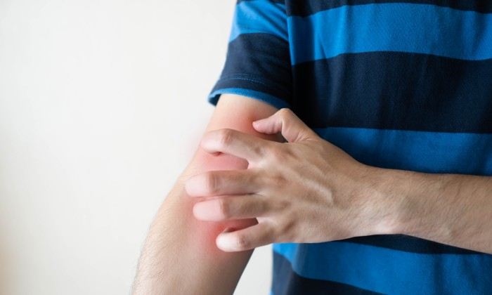 กลาก เกลื้อน ต่างกันอย่างไร