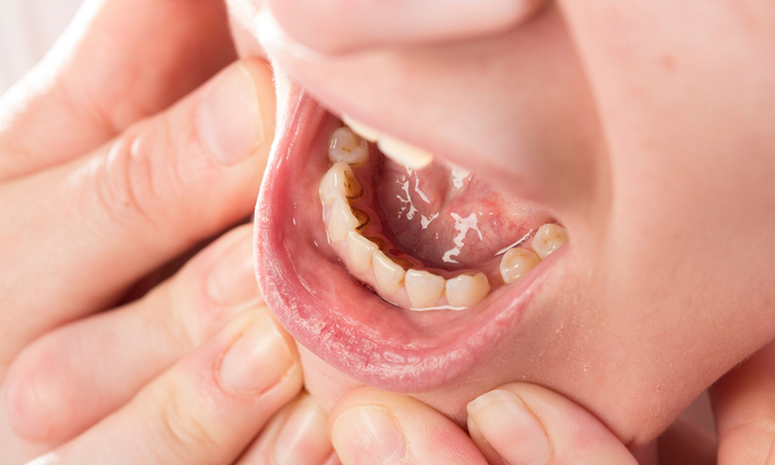 สัญญาณเตือนมะเร็งช่องปาก สังเกตเร็ว รับมือทัน