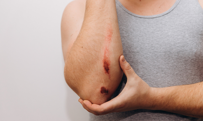 แผลถลอกบนผิวหนัง (Skin Abrasions)