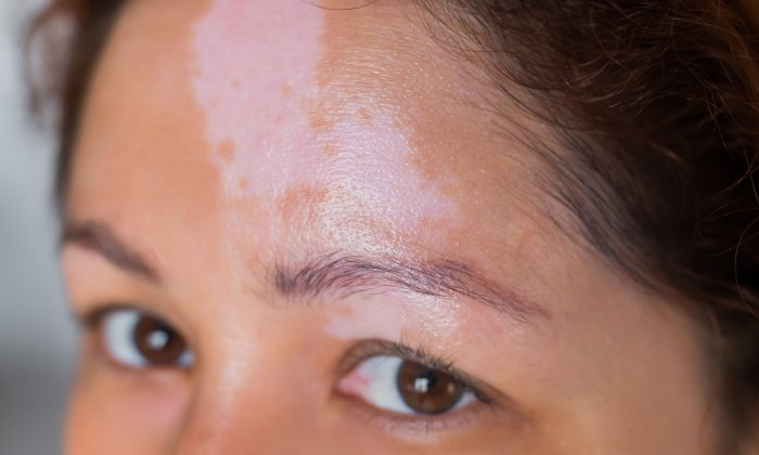 ด่างขาว อาการ สาเหตุ วิธีรักษา