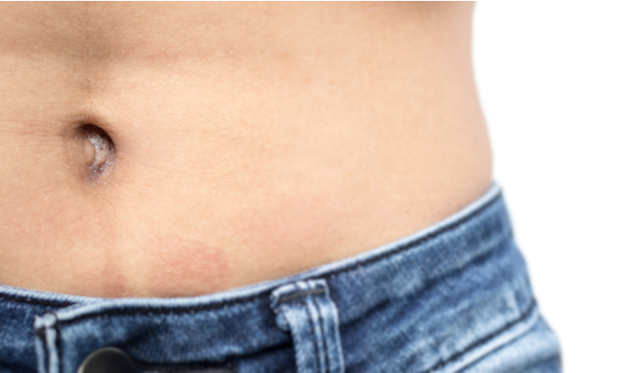 ขี้สะดือ หรือ ก้อนดำในสะดือ สามารถจัดการได้อย่างไร