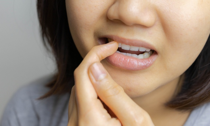 จุดที่ฟัน สัญญาณของฟันผุ ที่เกิดจากการดูแลฟันไม่ดี