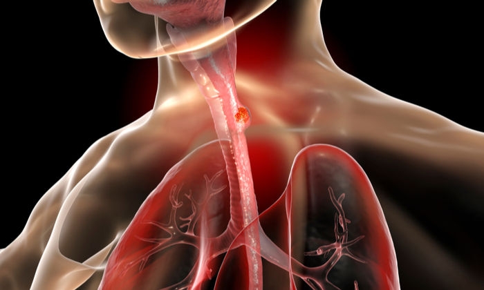 ความเสี่ยงเป็นมะเร็งหลอดอาหาร เกิดได้จากการสูบบุหรี่